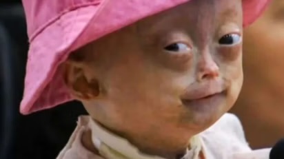 Elis Lima Carneiro, niña brasileña que ayudó a visibilizar la progeria en redes sociales